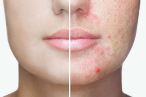 acne marni wellness beauty acne marni wellness beauty